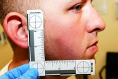 A small ruler held up to a man's face, measuring a bruise on his cheek.